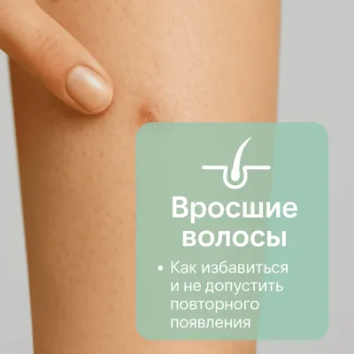 Вросшие волосы: как избавиться и не допустить повторного появления