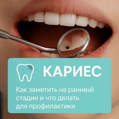 Кариес: как заметить на ранней стадии и что делать для профилактики