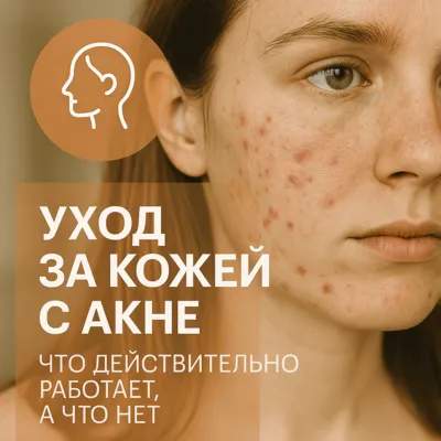 Уход за кожей с акне: что действительно работает, а что нет