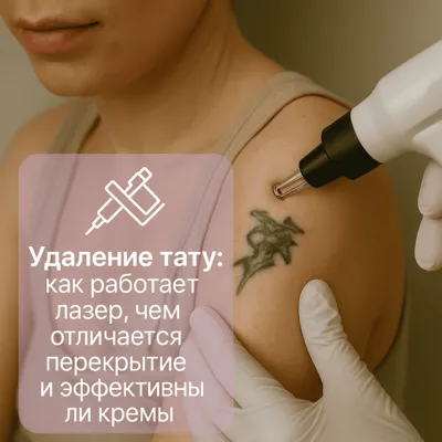 Удаление тату: как работает лазер, чем отличается перекрытие и эффективны ли кремы